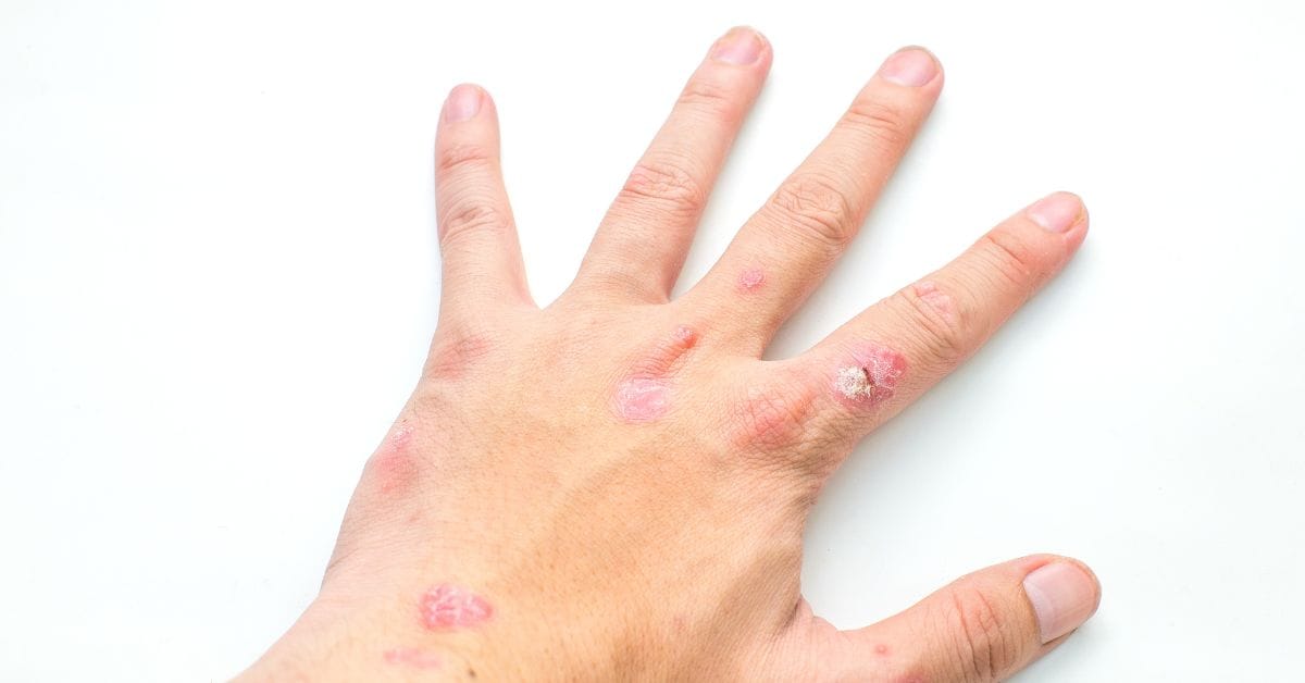 Takeda Releases Phase 3 Data for Zasocitinib in Plaque Psoriasis