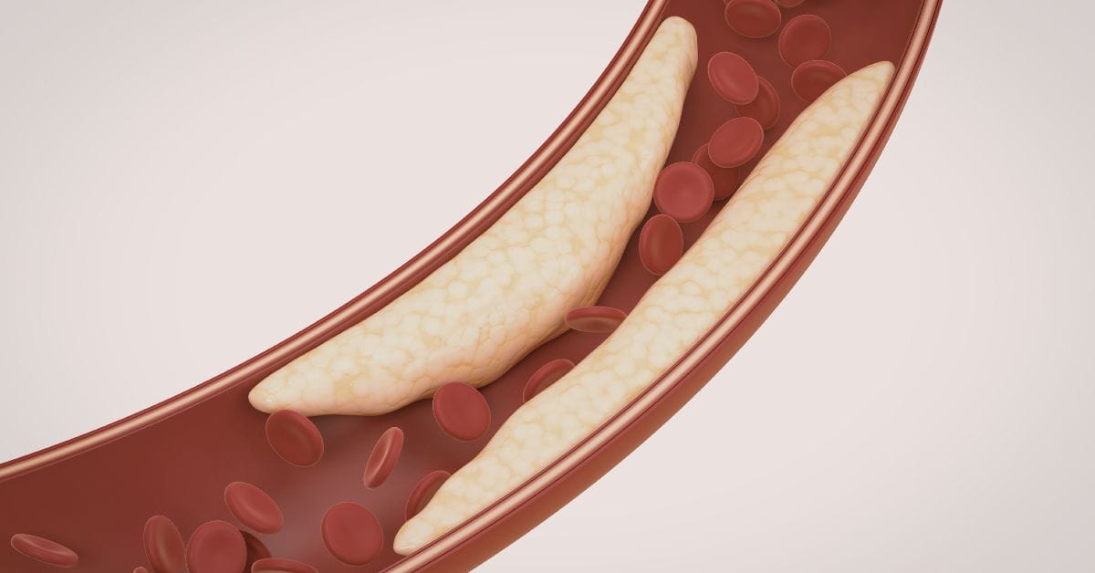 Johnson & Johnson Showcases Shockwave IVL for Calcified Artery DiseaseJohnson & Johnson Showcases Shockwave IVL for Calcified Artery Disease