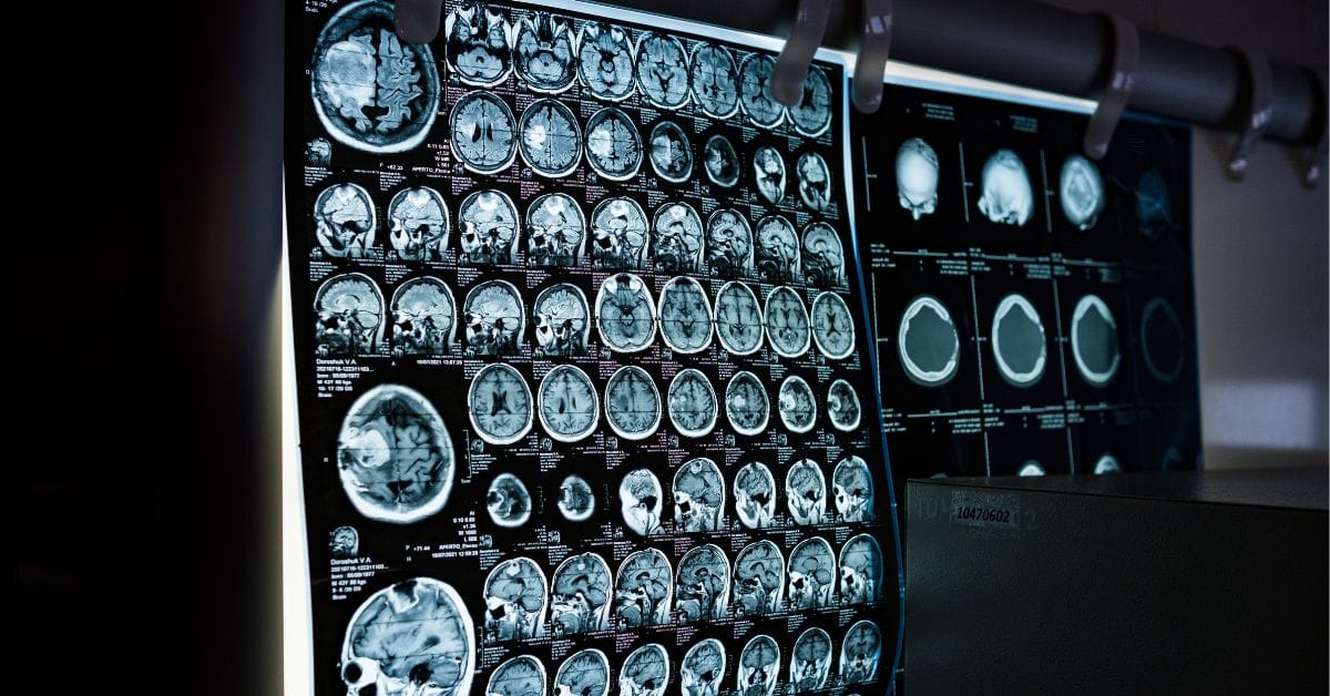 Siemens Healthineers Showcases Innovations at AOCR 2025