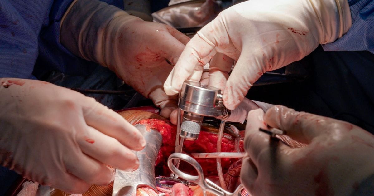 LVAD Implantation Surgery