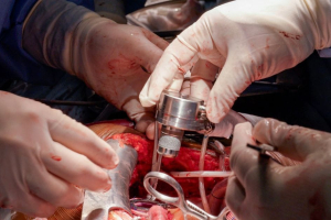 LVAD Implantation Surgery