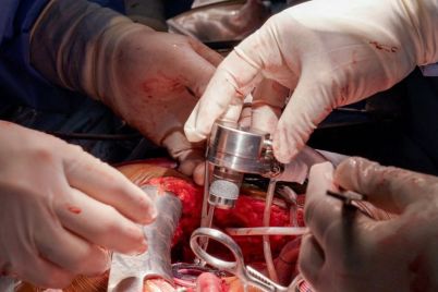 6-LVAD-Implantation-Surgery.jpg