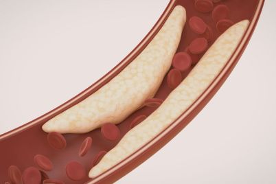 Johnson-Johnson-Showcases-Shockwave-IVL-for-Calcified-Artery-Disease.jpg