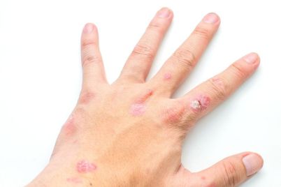 Takeda-Releases-Phase-3-Data-for-Zasocitinib-in-Plaque-Psoriasis-.jpg